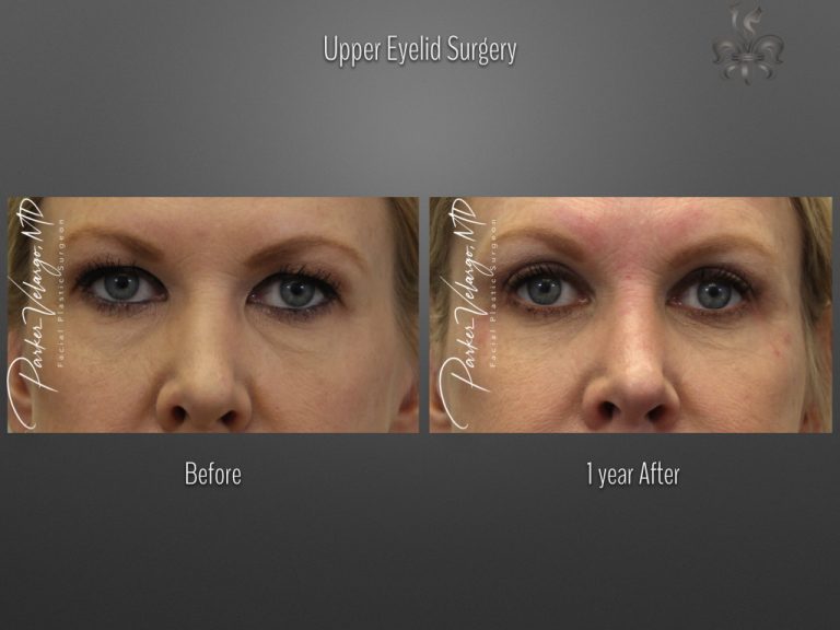 Blepharoplasty (Eyelid Surgery) before and after