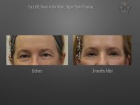 Blepharoplasty (Eyelid Surgery) before and after