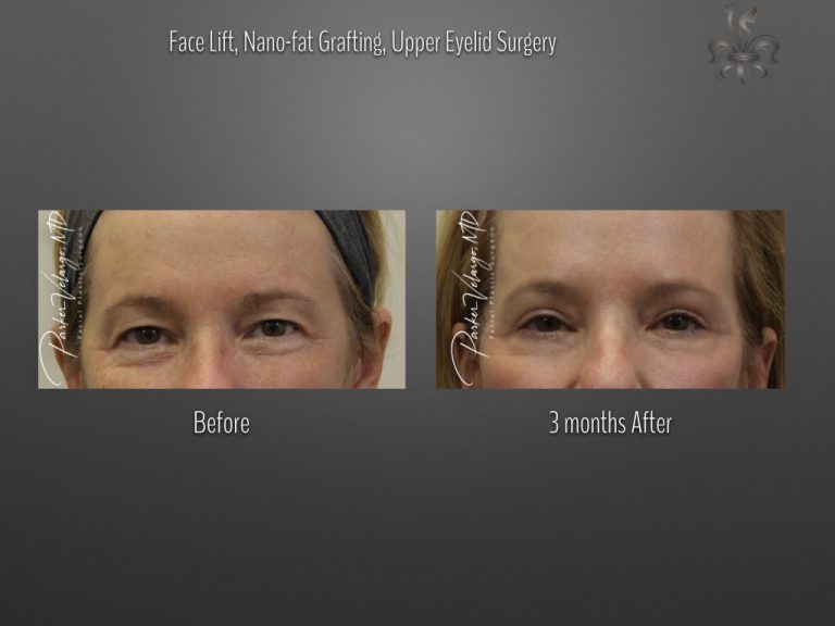 Blepharoplasty (Eyelid Surgery) before and after