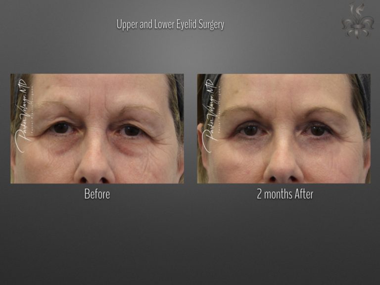 Blepharoplasty (Eyelid Surgery) before and after