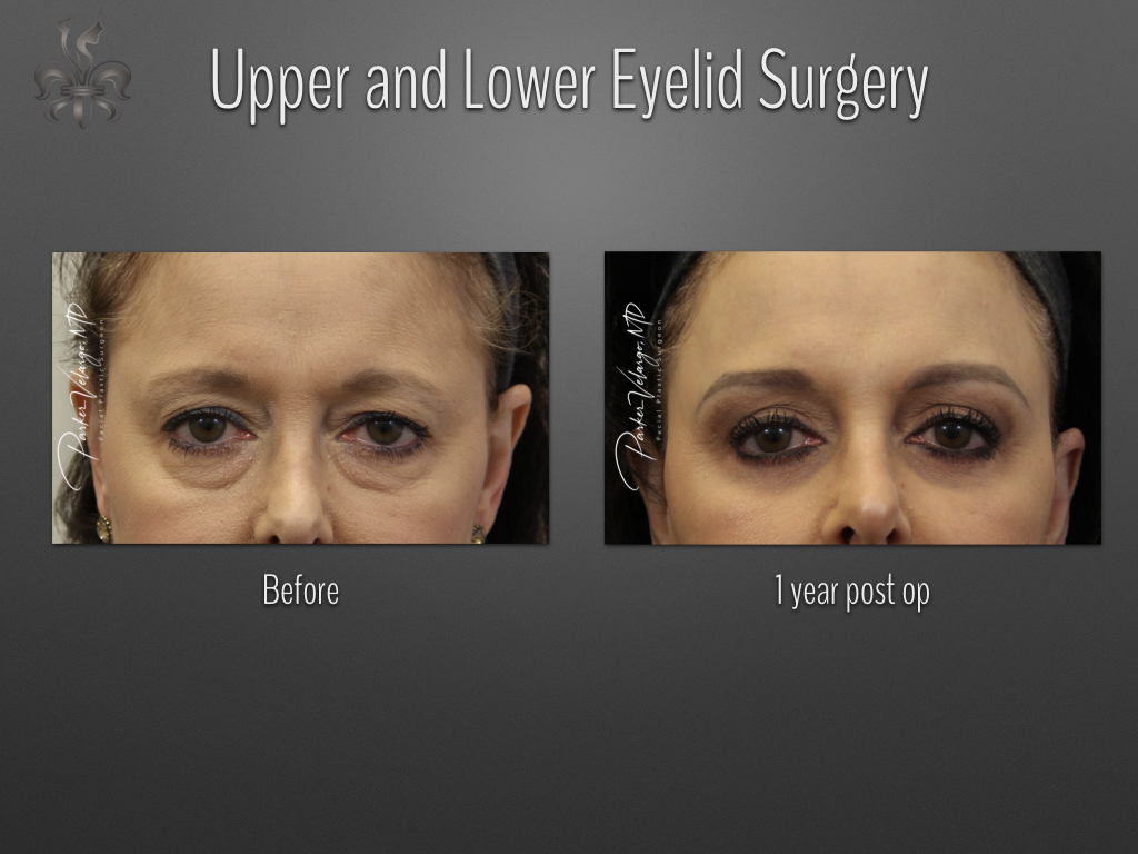 Blepharoplasty (Eyelid surgery) before and after