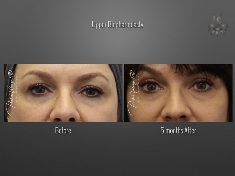 Blepharoplasty (Eyelid surgery) before and after