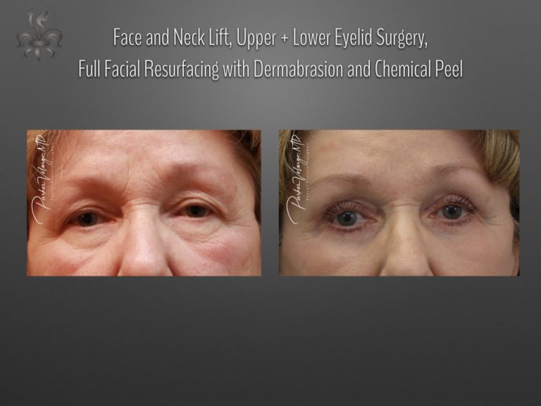 Blepharoplasty (Eyelid surgery) before and after