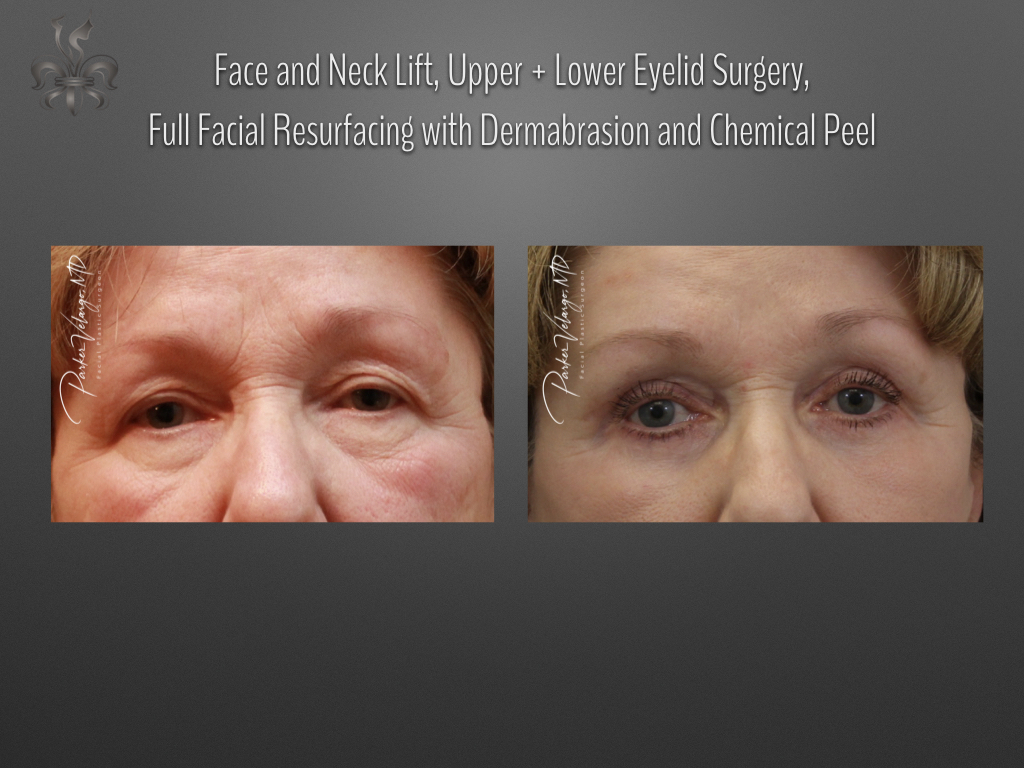 Blepharoplasty (Eyelid surgery) before and after
