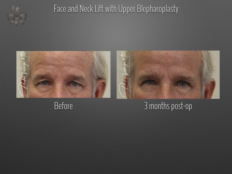 Blepharoplasty (Eyelid surgery) before and after