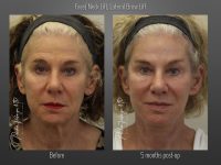 Brow Lift before and after