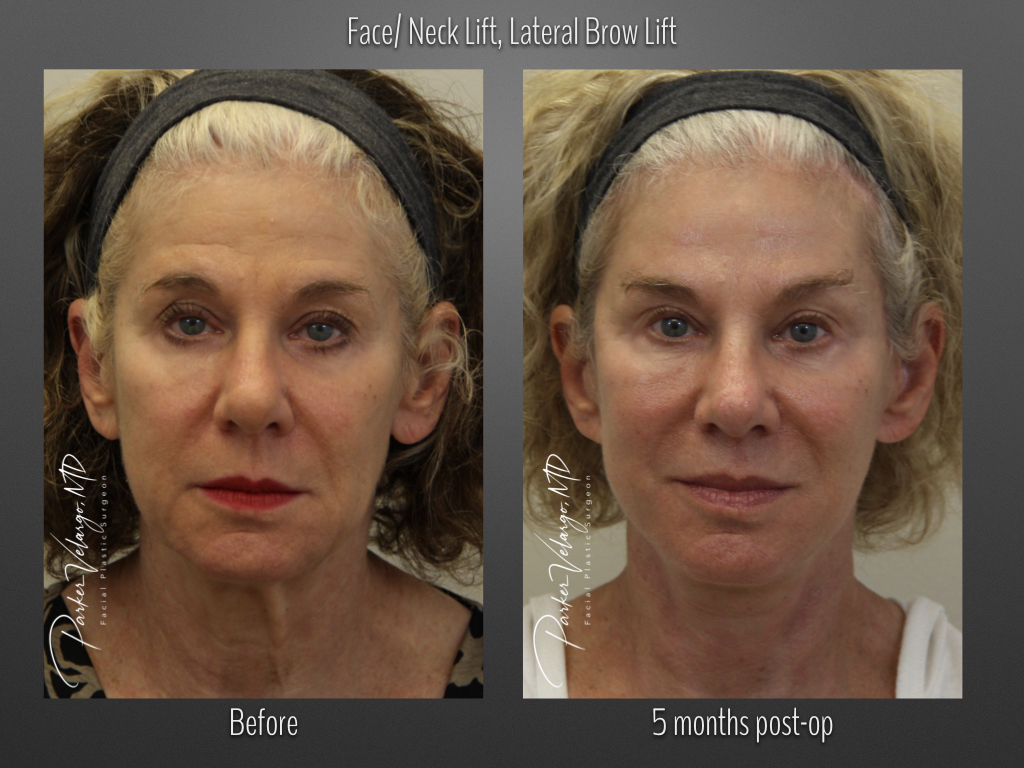 Brow Lift before and after