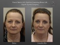 Brow Lift before and after