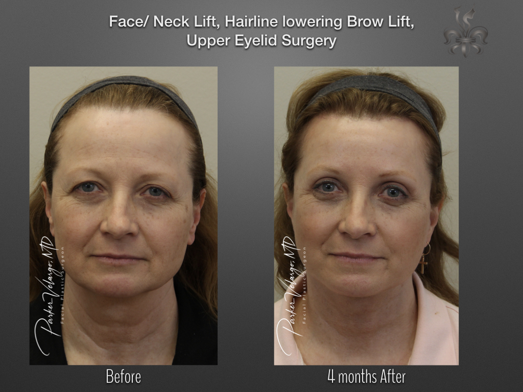 Brow Lift before and after