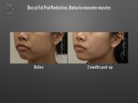 Buccal Fat Removal before and after