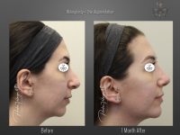 Chin Augmentation before and after