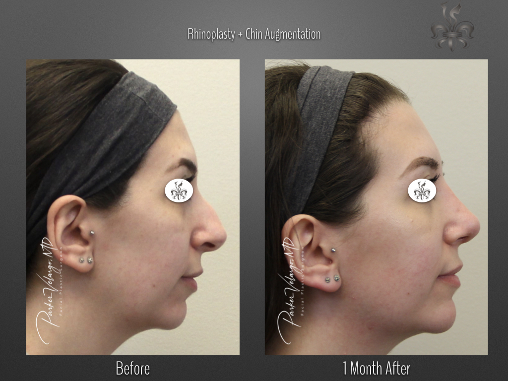 Chin Augmentation before and after