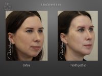 Chin Augmentation before and after