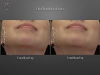 Chin Augmentation before and after