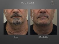 Direct Neck Lift before and after