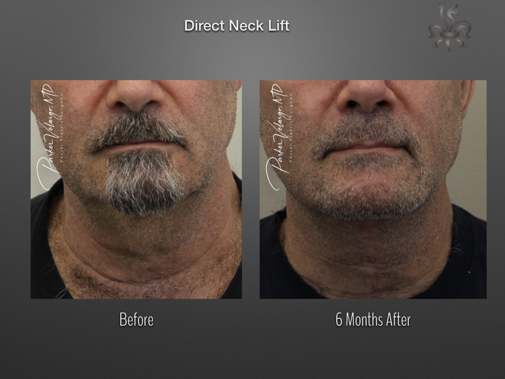 Direct Neck Lift before and after