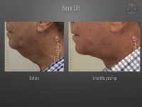 Face/Neck Lift before and after