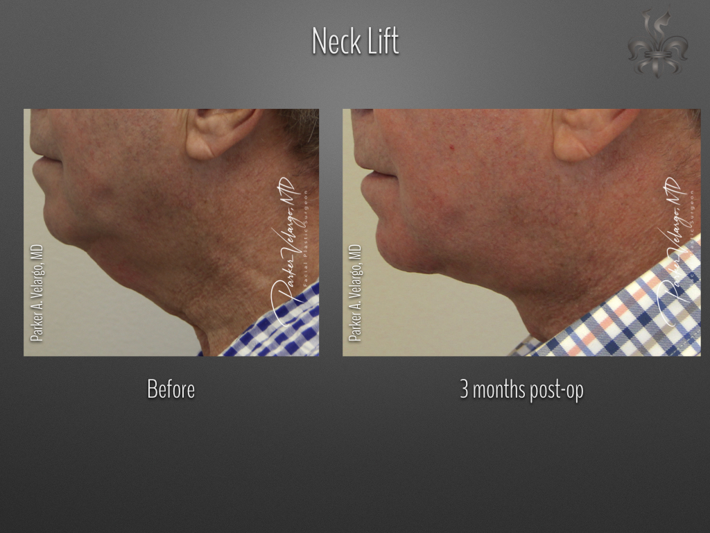 Direct Neck Lift Case 3727 New Orleans Premier Center For Aesthetics And Plastic Surgery