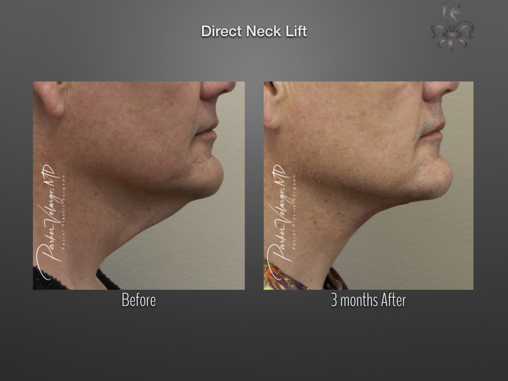 Direct neck lift before and after