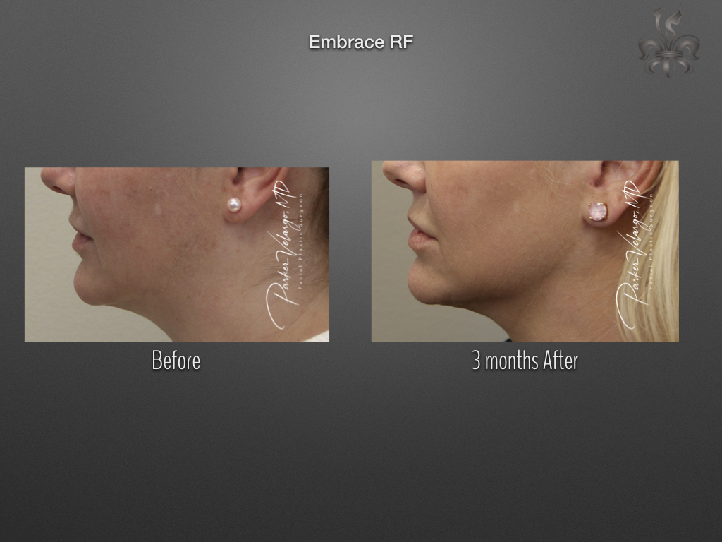 EmbraceRF before and after
