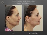 Face/Neck Lift before and after