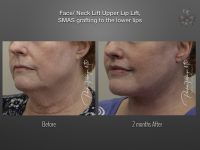 Face/Neck Lift before and after