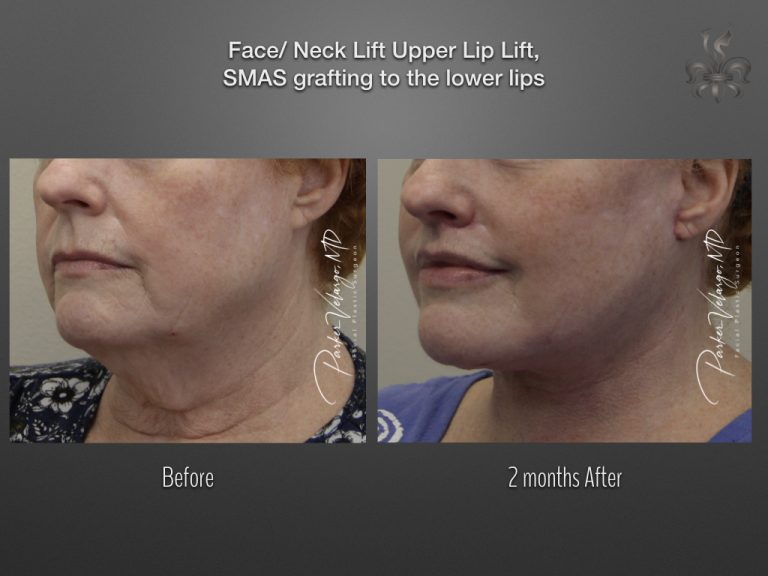 Face/Neck Lift before and after