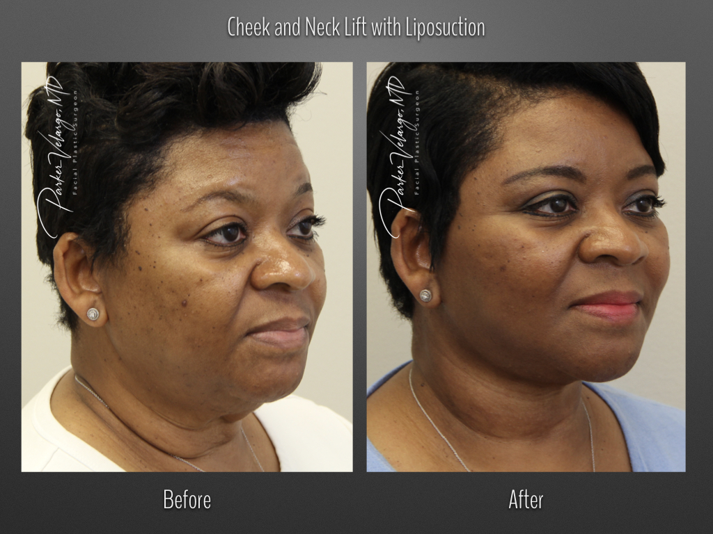 Face/Neck Lift before and after