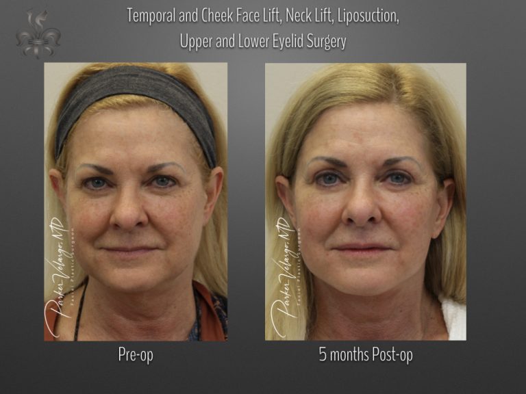 Face/Neck Lift before and after