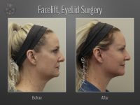 Face/Neck Lift before and after