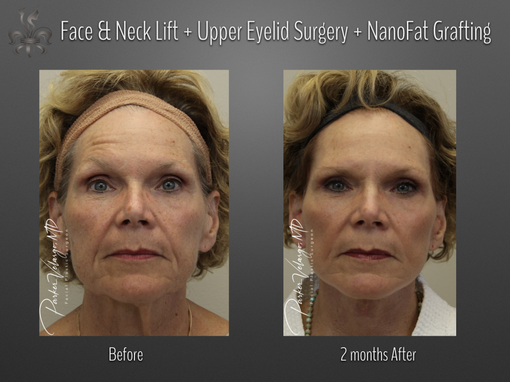 Face/Neck Lift before and after