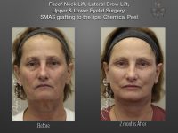 Face/Neck Lift before and after