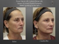 Face/Neck Lift before and after