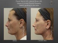 Face/Neck Lift before and after