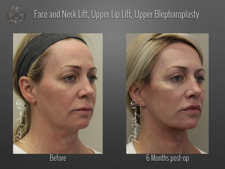 Face/Neck lift before and after