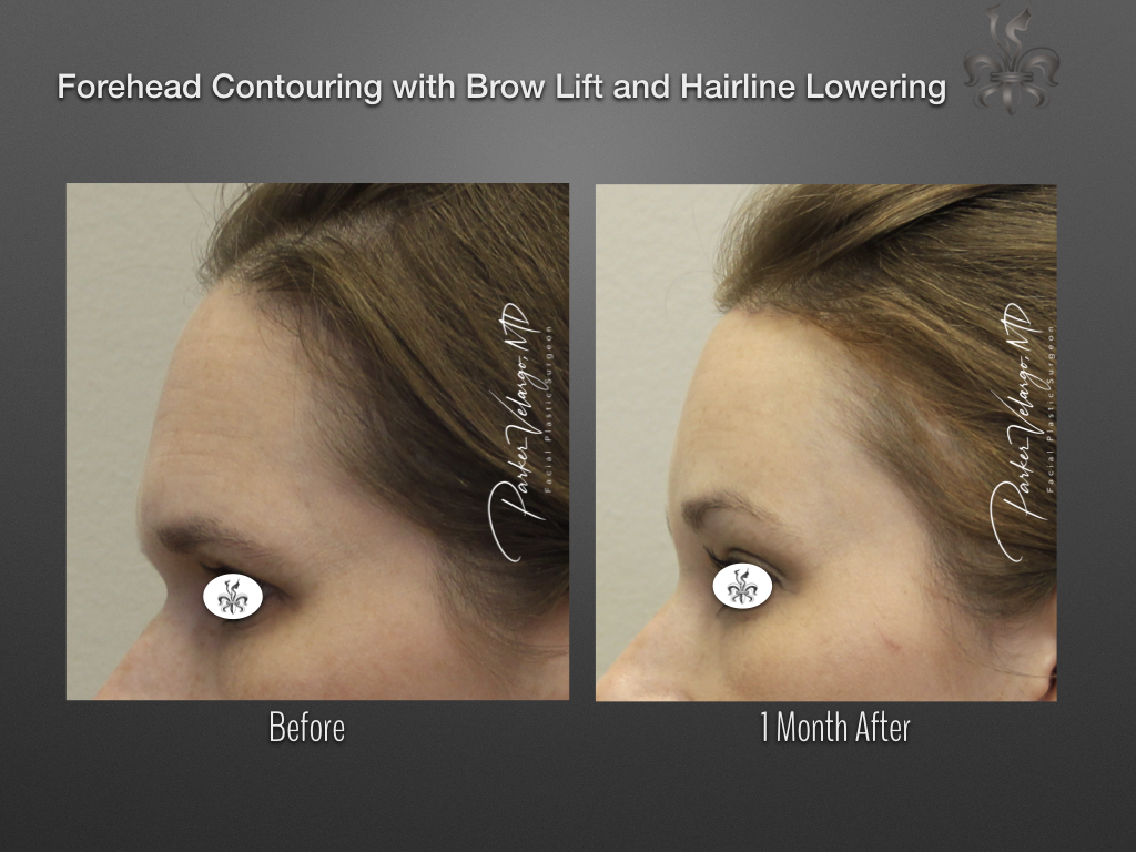 Facial Feminization before and after