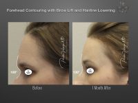 Facial Feminization before and after