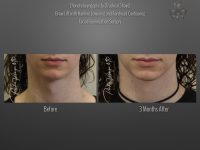 Facial Feminization before and after