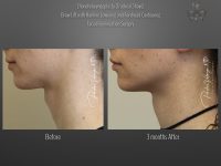 Facial Feminization before and after