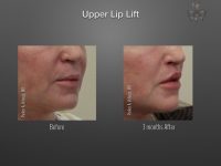 Lip Lift before and after
