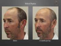 Otoplasty before and after