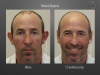 Otoplasty before and after
