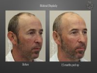 Otoplasty before and after