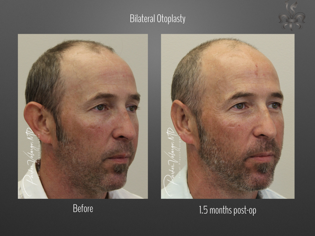 Otoplasty before and after