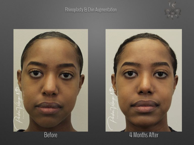 Rhinoplasty before and after