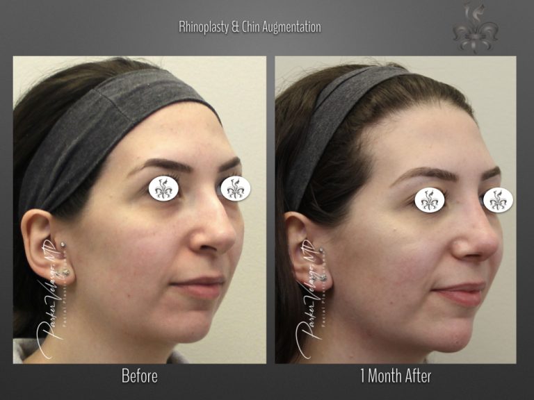 Rhinoplasty before and after