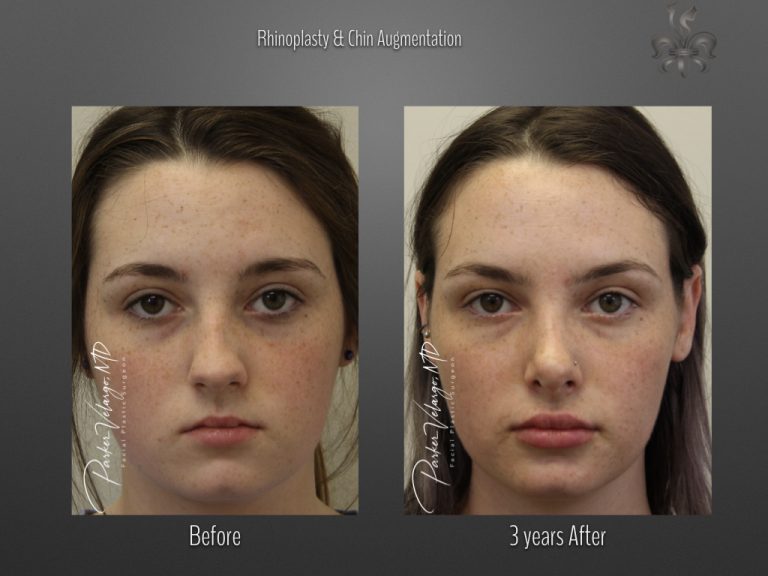 Rhinoplasty before and after