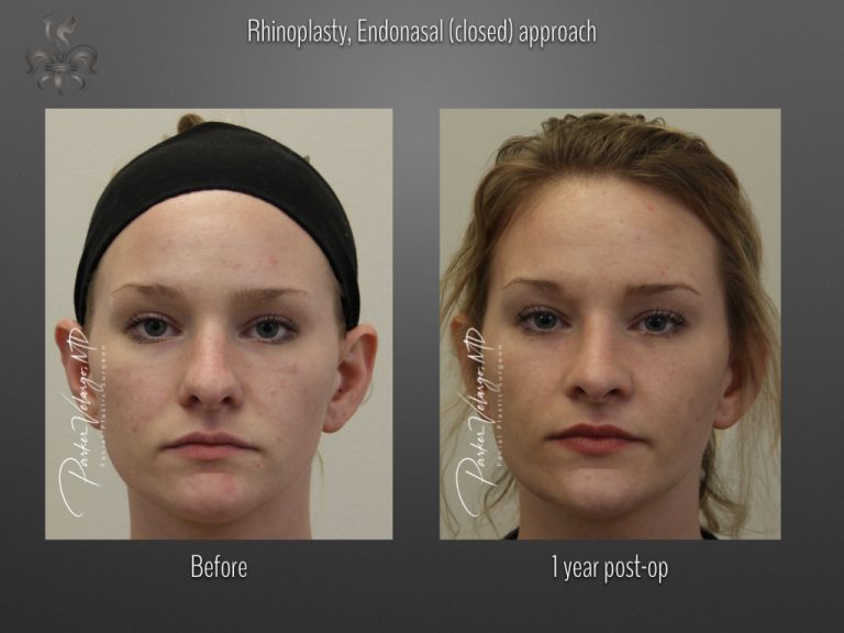 Rhinoplasty before and after