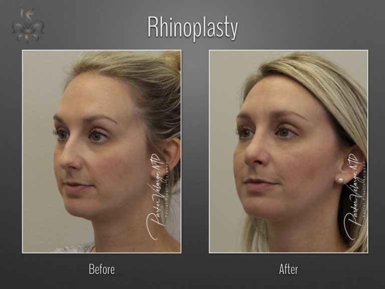 Rhinoplasty before and after