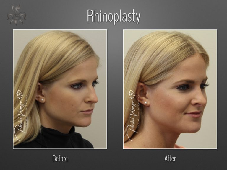 Rhinoplasty before and after